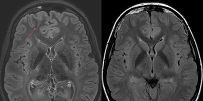 Images from Leiden University Medical Centre show current clinical applications for epilepsy showing 3 Tesla focal cortical dysplasia initially missed (at right) and 7 Tesla dysplasia easily seen.