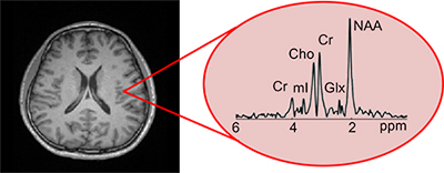 The imaging technology Fan Lam and colleagues are developing allows researchers to map biochemical profiles of the brain at an unprecedentedly high resolution, adding another dimension of information to the anatomical information obtained from standard MRI exams (image on the left).