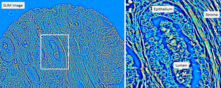 Left: Quantitative phase image of an unstained prostatectomy sample from a patient who had a biochemical recurrence of prostate cancer. Right: A zoomed-in region from the quantitative phase image showing a cancerous gland with debris in the lumen. The stroma, or supportive tissue environment, shows discontinuities in the fiber length and disorganization in the orientation of the fibers.