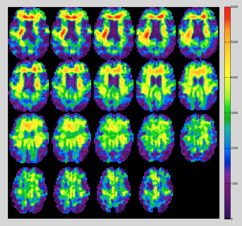 A series of brain images showing different colors through magnetic resonance elastography.