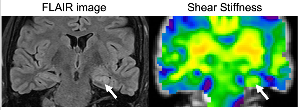 MRE of the brain FLAIR vs shear