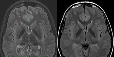  Images from Leiden University Medical Centre show current clinical applications for epilepsy showing 3 Tesla focal cortical dysplasia initially missed (at right) and 7 Tesla dysplasia easily seen.