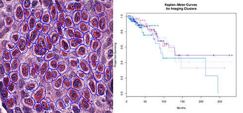 Breast cancer cells