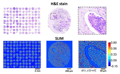 Tissue microarray imaged by bright field (top) and SLIM (bottom).