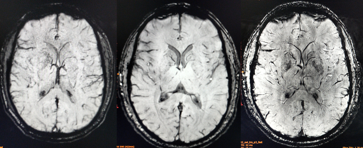 Brain MRI: How to read MRI brain scan | Kenhub