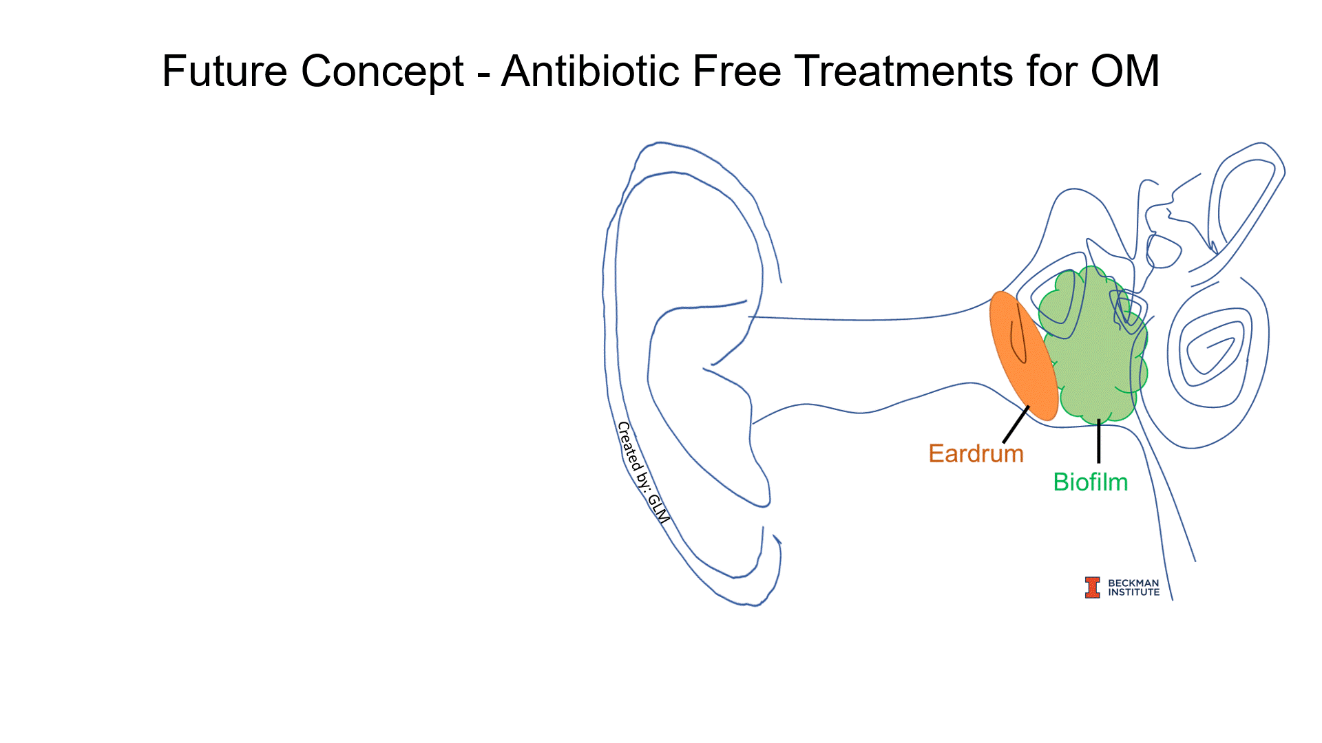 The antibiotic-free treatment Monroy is developing uses a plasma device outside the ear. UV light from the plasma device breaks up individual atoms of oxygen and nitrogen molecules that flow into the ear and reduce bacterial levels.