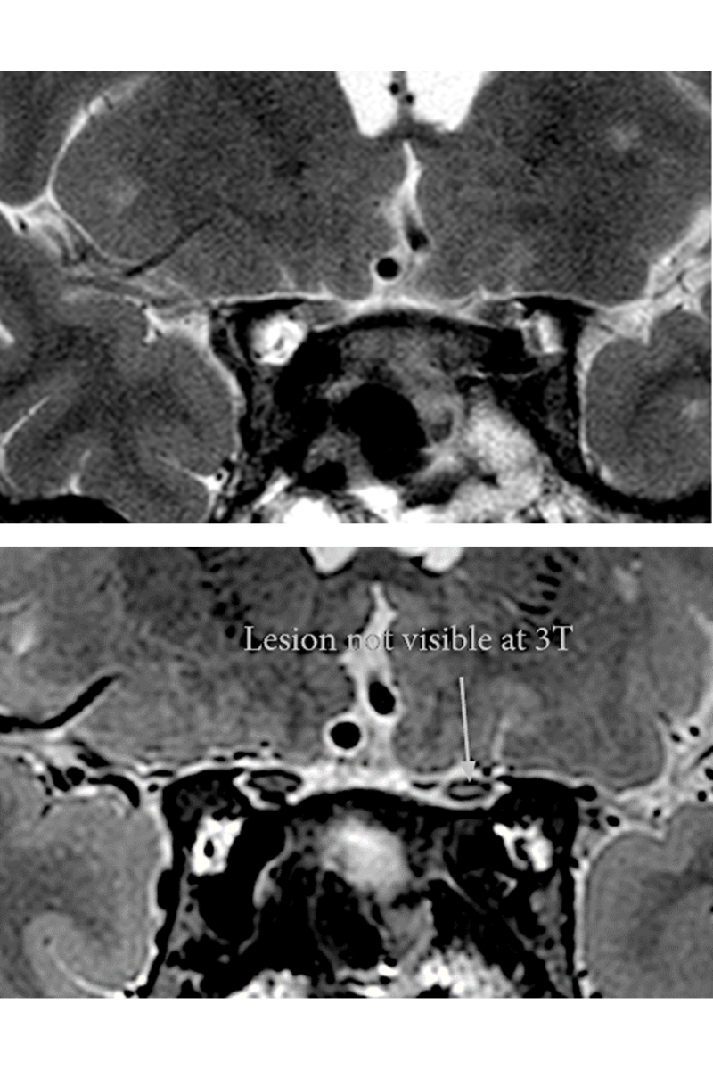 Two images of the same patient's optic chiasm reveal that 7 Tesla resolution makes a lesion visible that cannot be seen at 3 Tesla resolution.